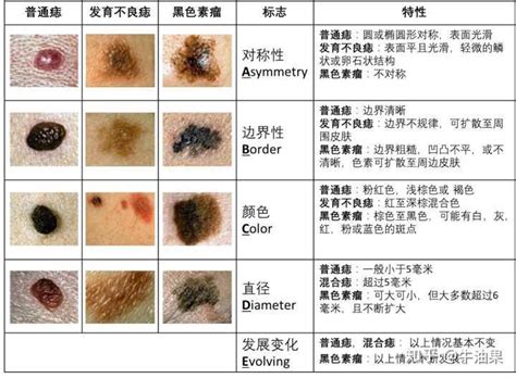 身體有痣|是痣還是瘤？黑色素瘤的類型、症狀與治療